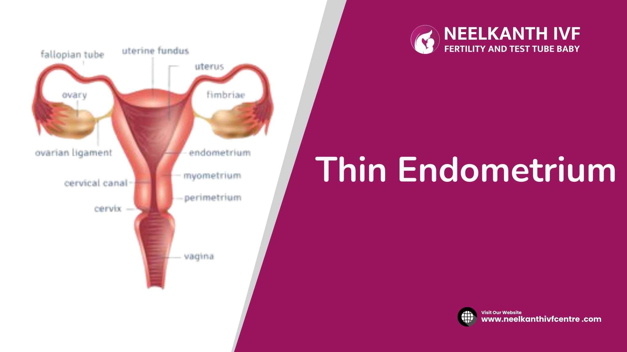 Thin Endometrium - Neelkanth IVF