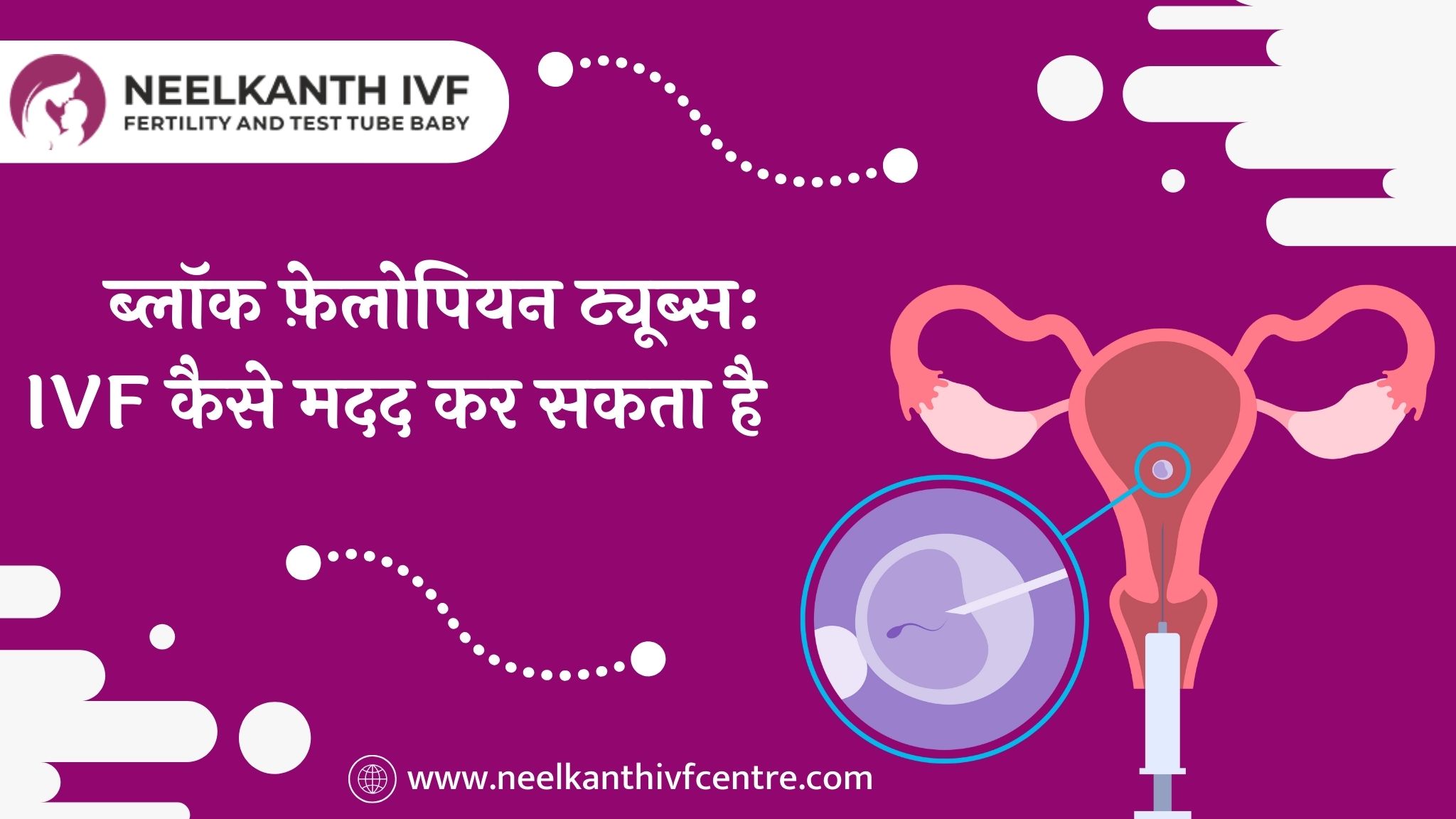 ब्लॉक फ़ेलोपियन ट्यूब्स: IVF कैसे मदद कर सकता है - Neelkanth IVF