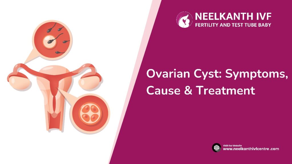 Ovarian Cyst - Neelkanth IVF