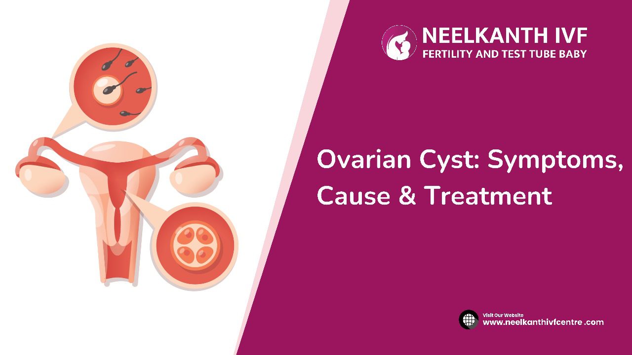 Ovarian Cyst - Neelkanth IVF