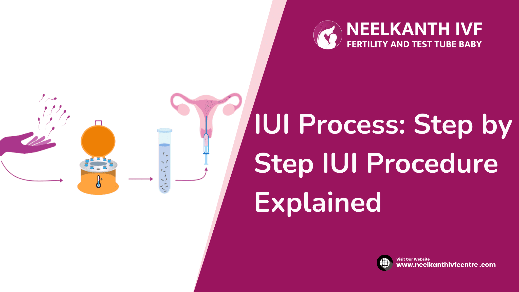 IUI Process: Step by Step IUI Procedure Explained - Neelkanth IVF