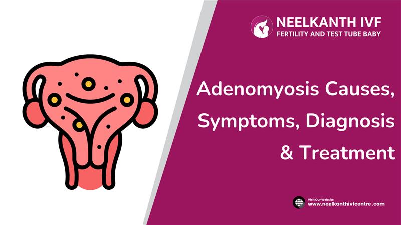 Learn about adenomyosis, its causes, symptoms, diagnosis, and treatment options. Understand how this condition affects uterus and ways to manage it effectively - Neelkanth IVF