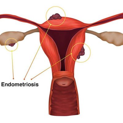 PA6G8X Endometriosis, illustration. A condition in which the endometrium, the layer of tissue that normally covers the inside of the uterus, grows outside of it.