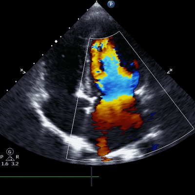 USG Scrotal Doppler